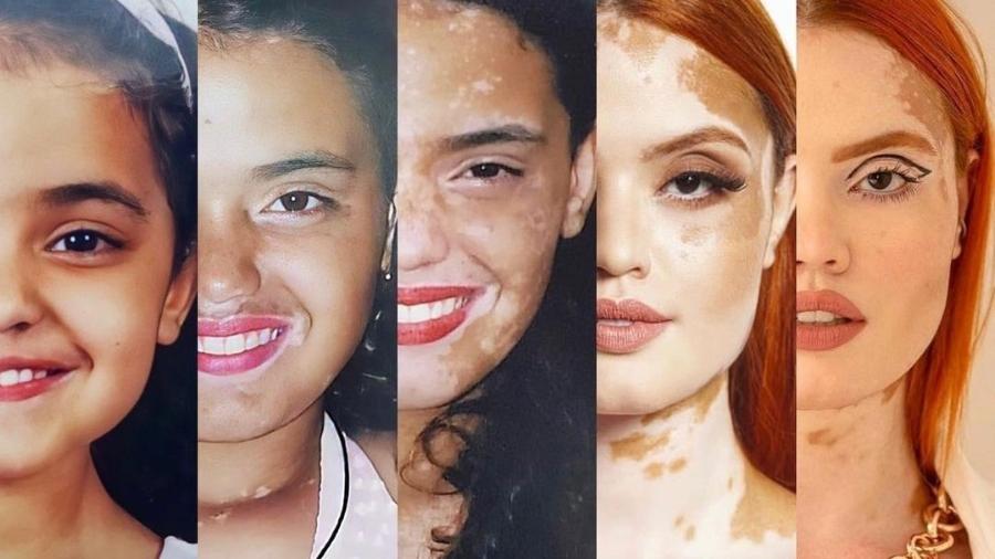 A influenciadora Barbarhat Sueyassu, que tem vitiligo universal