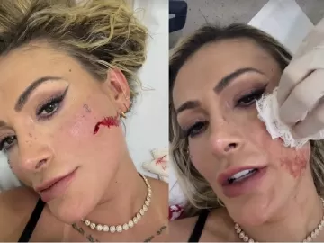 Urach e Juju Ferrari brigam de novo e atriz pornô leva 4 pontos no rosto