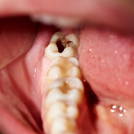 A decadência dental pode levar à formação de cavidades - iStock