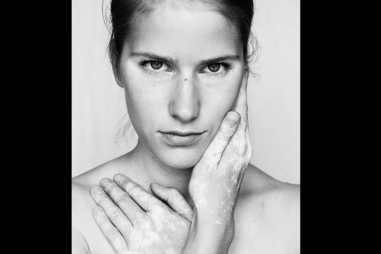 Modelos com vitiligo - Divulgação/Julia Kaczorowska