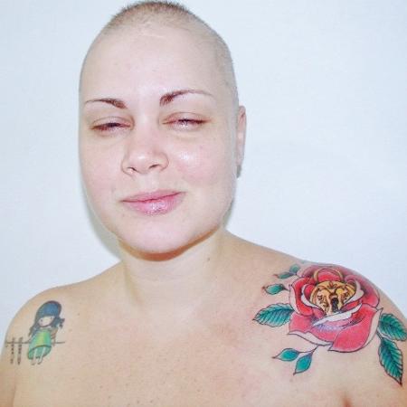 Silvia Kineippe, 37, diagnosticada com tricotilomania - Arquivo Pessoal