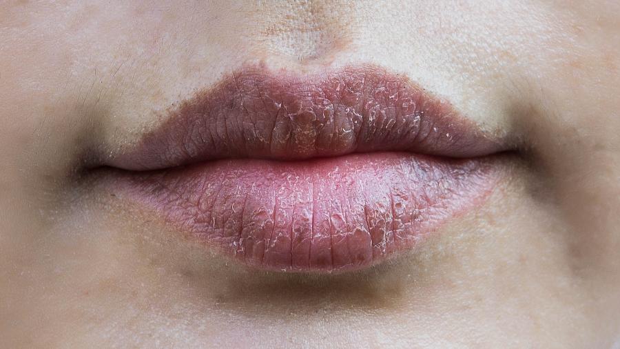 Usar produtos específicos e beber mais água pode ajudar a evitar ressecamento dos lábios - Getty Images