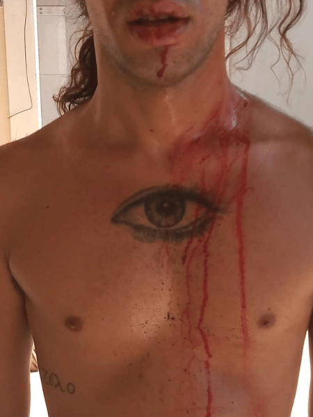 Guilherme Azevedo teve ferimentos nos ombros, nos dedos e no rosto - Reprodução/Instagram