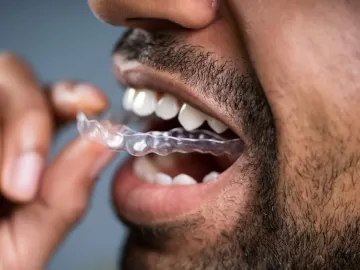 Duas vezes mais rápido e sem dor: aparelho dental 'invisível' se modernizou