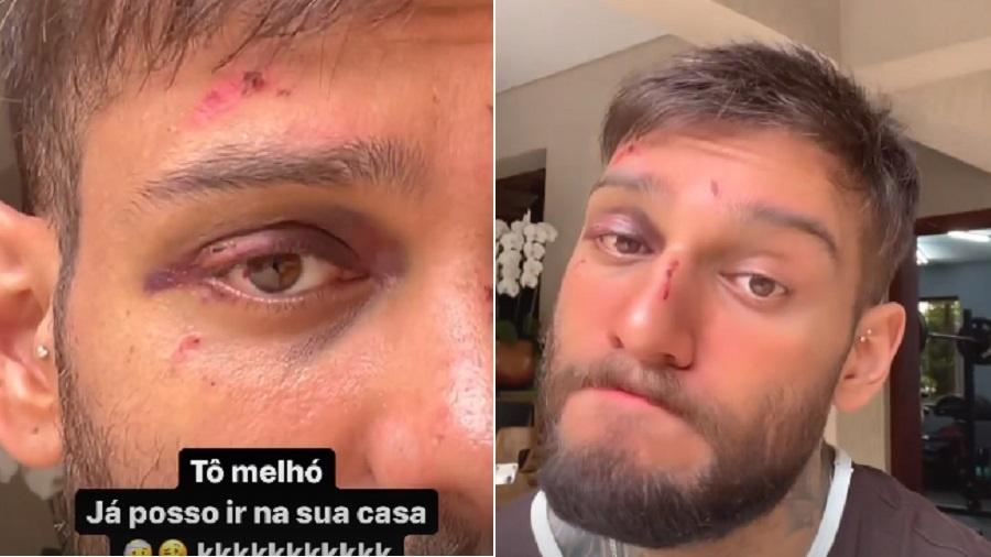 Lucas Lucco mostra estado dos machucados em seu rosto após acidente em casa - Reprodução/Instagram