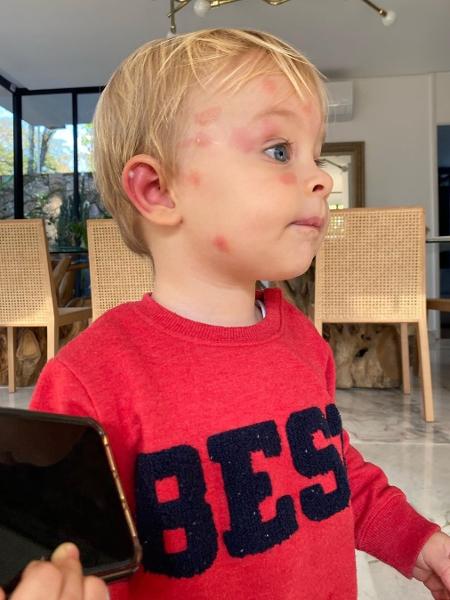 A influenciadora compartilhou fotos de Filippo com manchas no rosto após ser picado por um mosquito - Reprodução/Instagram