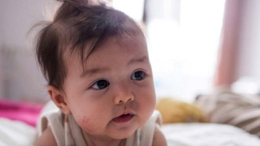 Crianças com eczema, que causa pele seca, lesões da pele e coceira, são particularmente vulneráveis a desenvolver alergia alimentar - Getty Images