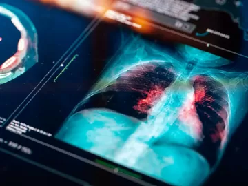 Câncer de pulmão: remédio reduz avanço de tipo da doença, mostra estudo