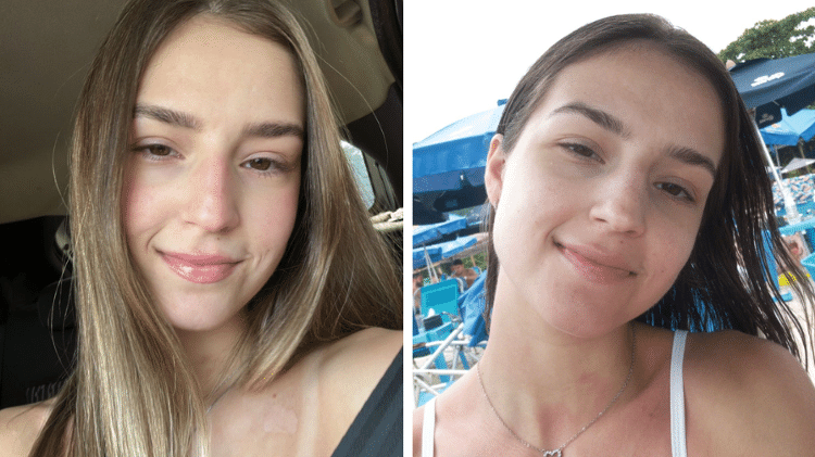 Rosto da Letícia após o terceiro tratamento contra acne Rosto da Letícia após o terceiro tratamento contra acne