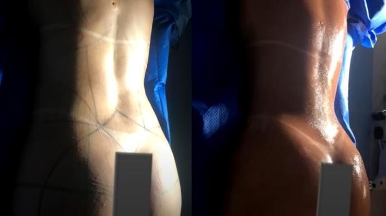 Viih Tube antes e depois da lipo LAD - Reprodução/YouTube - Reprodução/YouTube
