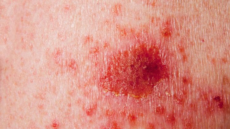 carcinoma - iStock - iStock