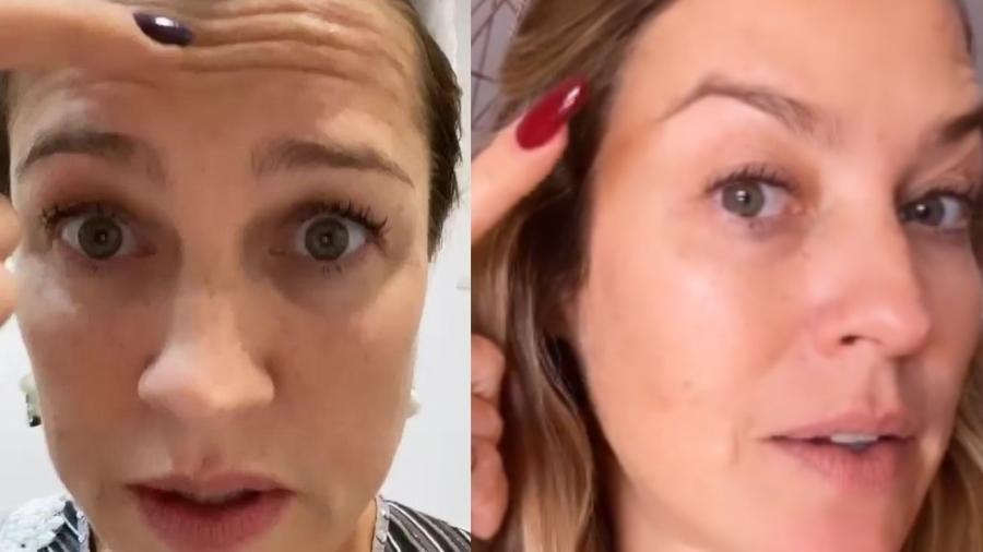 Luana Piovan,i antes e depois do procedimento de remoção de linhas de expressão - Reprodução/Instagram