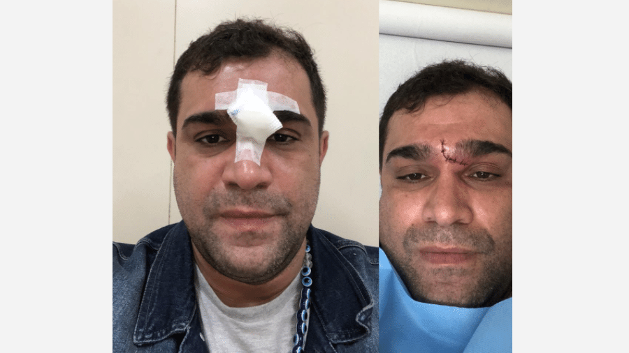 Evandro Santo mostra machucado no rosto - Reprodução/Instagram