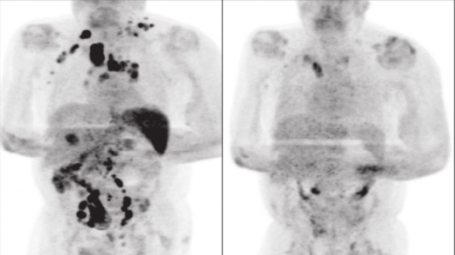 Imagem mostra remissão da doença antes e após diagnóstico de covid-19 - Reprodução/British Journal of Haematology