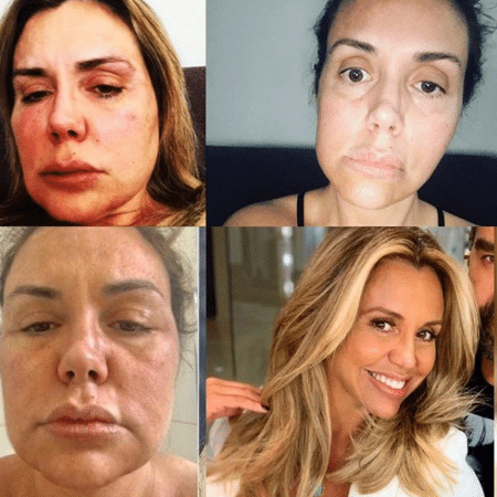 Renata Banhara em fotos antes e durante tratamento de infecção, que começou em 2016 - Reprodução/Instagram/@rebanhara