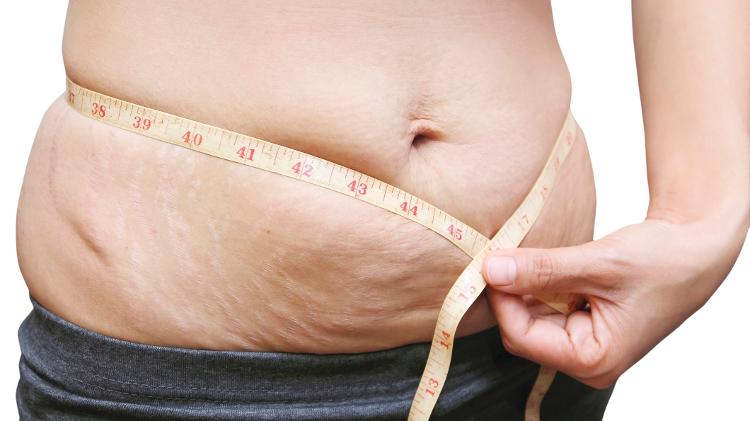 Barriga flácida/ Barriga após emagrecer - iStock - iStock