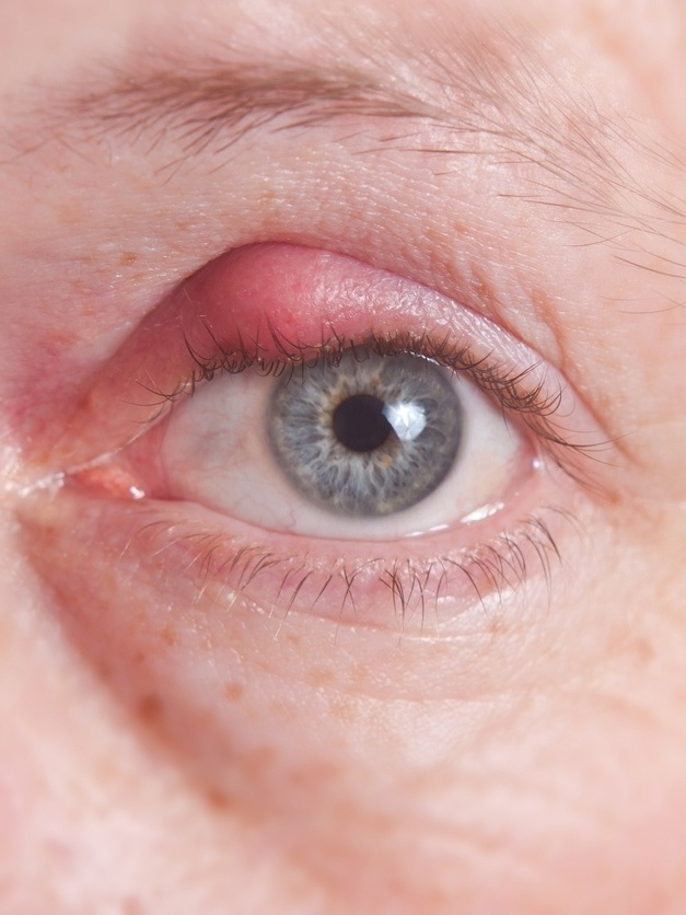 Você sabe o que causa o terçol no olho?
