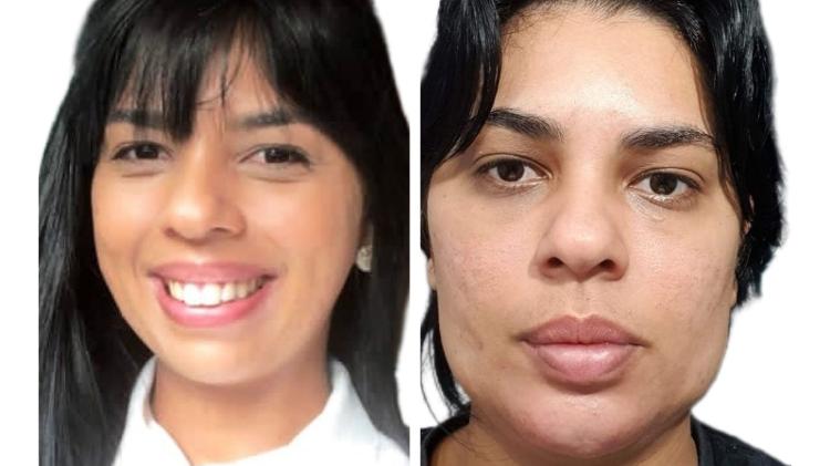 A pele do rosto da empresária Tarcila Queiroz Oliveira ficou flácida após uma bichectomia