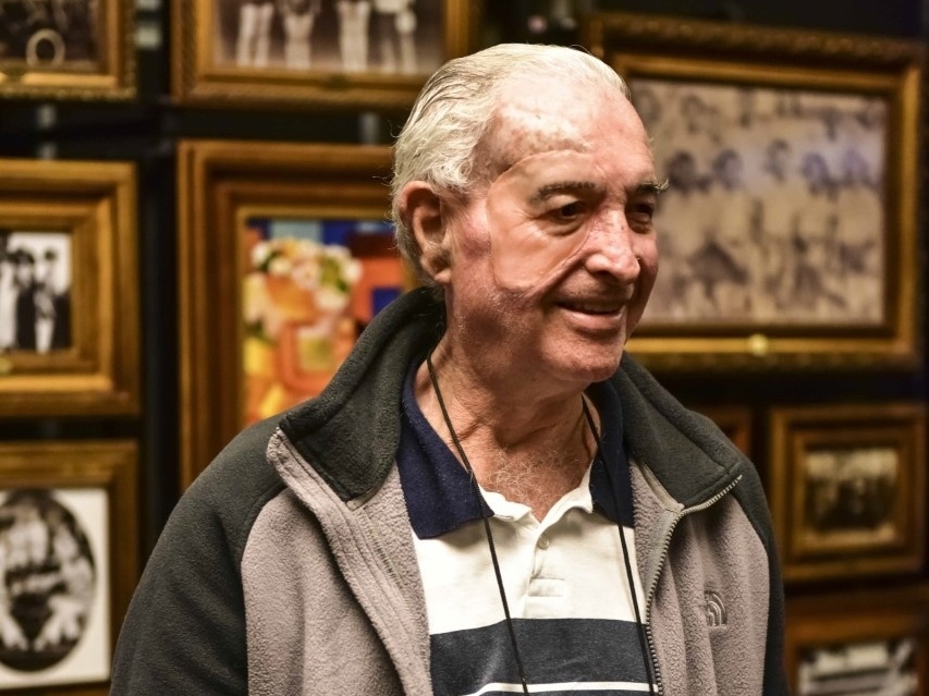 Projeto dá próteses faciais a quem sofreu deformações por câncer