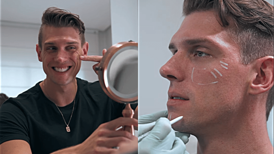 BBB 23: Cristian entra na moda da harmonização facial; veja resultado