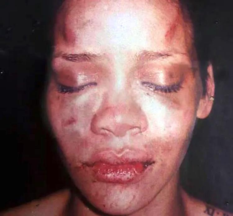 Jamais esqueceremos: Rihanna em foto que mostra as marcas de violência de Chris Brown