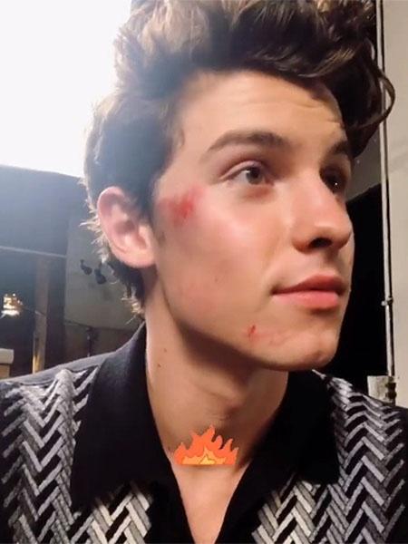 Shawn Mendes mostra hematomas no rosto após queda de patinete motorizado - Reprodução/Instagram