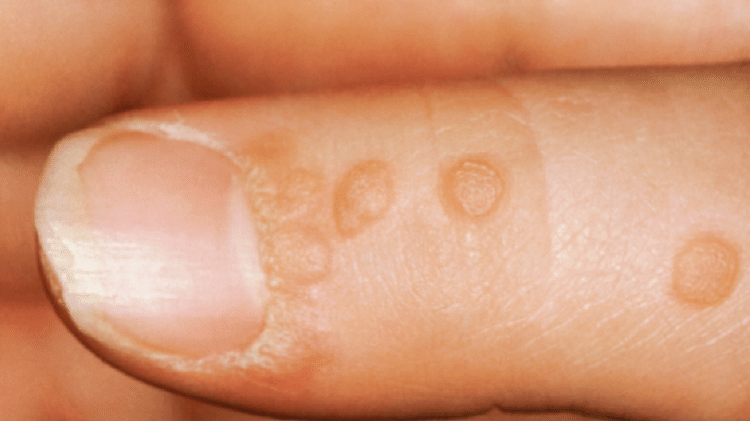 Verruga nas unhas - Reprodução/Clinical Photography/Science Photo Library - Reprodução/Clinical Photography/Science Photo Library