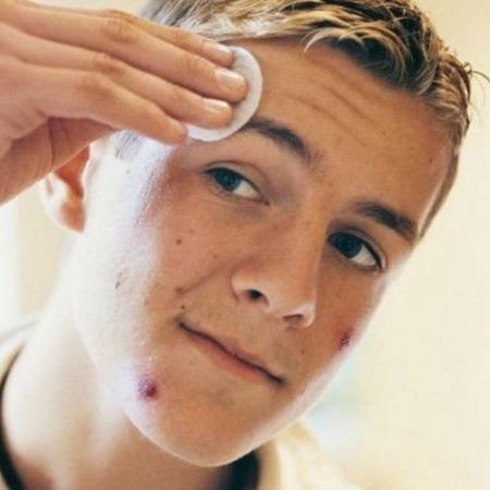 Acne pode ajudar a manter a juventude da pele, indica estudo - Thinkstock