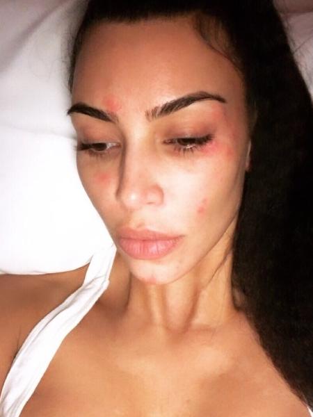 Kim Kardashian mostrou rosto com psoríase no Instagram na manhã deste domingo (17) - Reprodução/Instagram