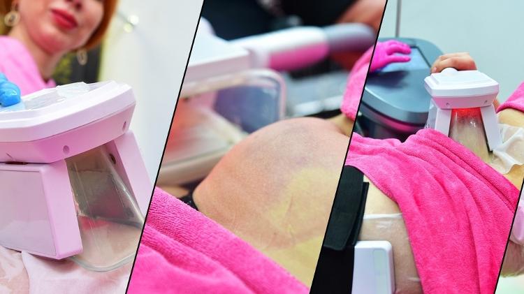 Criolipólise 2 - iStock - iStock