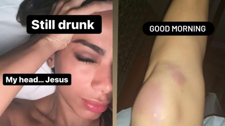Anitta acorda com hematomas e dor de cabeça após festa de aniversário - Reprodução/Instagram