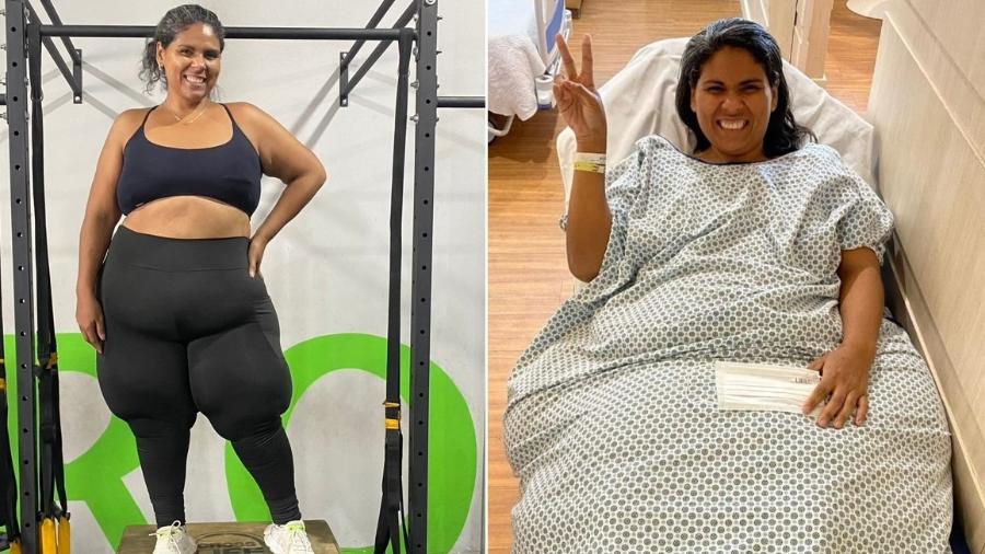 Tamiris de Sá, 36, tem lipedema em estágio mais avançado; ela já passou por duas cirurgias