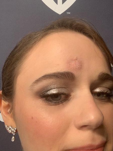 Joey King mostra hematoma após "cabeçada" em Globo de Ouro de Patricia Arquette - Reprodução/Twitter