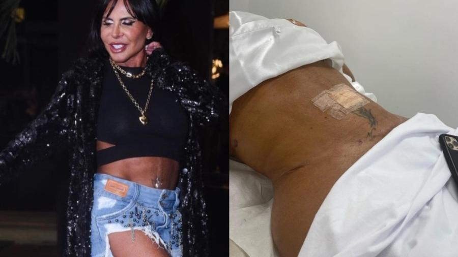 Gretchen comemora lipoaspiração 12 dias após o procedimento estético - Reprodução/Instagram