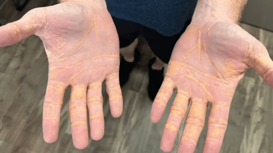 Homem ficou com mãos amarelas após seguir dieta carnívora