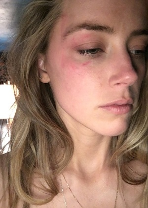 Amber Heard mostra marcas no rosto. Atriz acusa Johnny Depp de violência doméstica - Reprodução/People