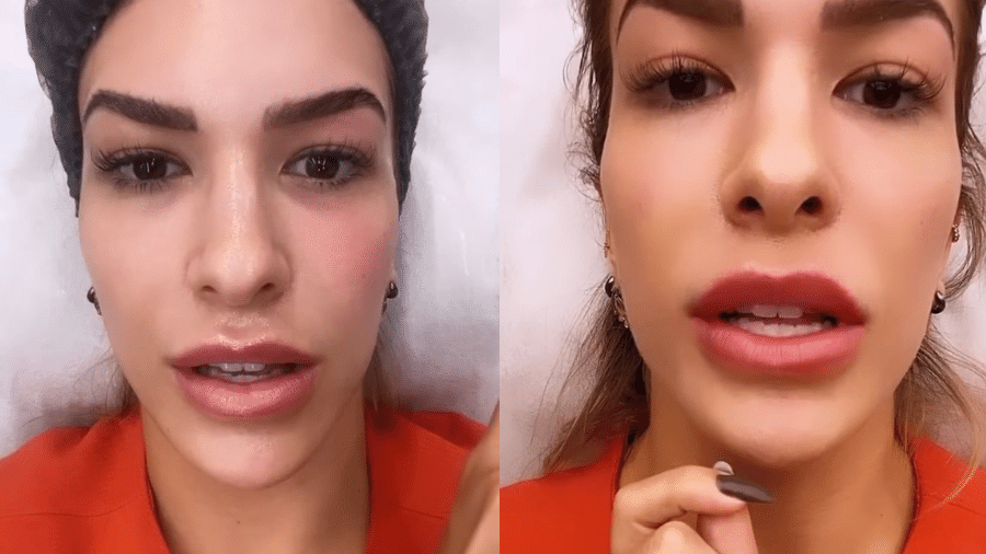 Lore Improta faz botox e preenchimento labial; veja antes e depois - 09