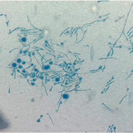 Paciente ficou bem após dois anos de acompanhamento - Divulgação/Medical Mycology Case Reports