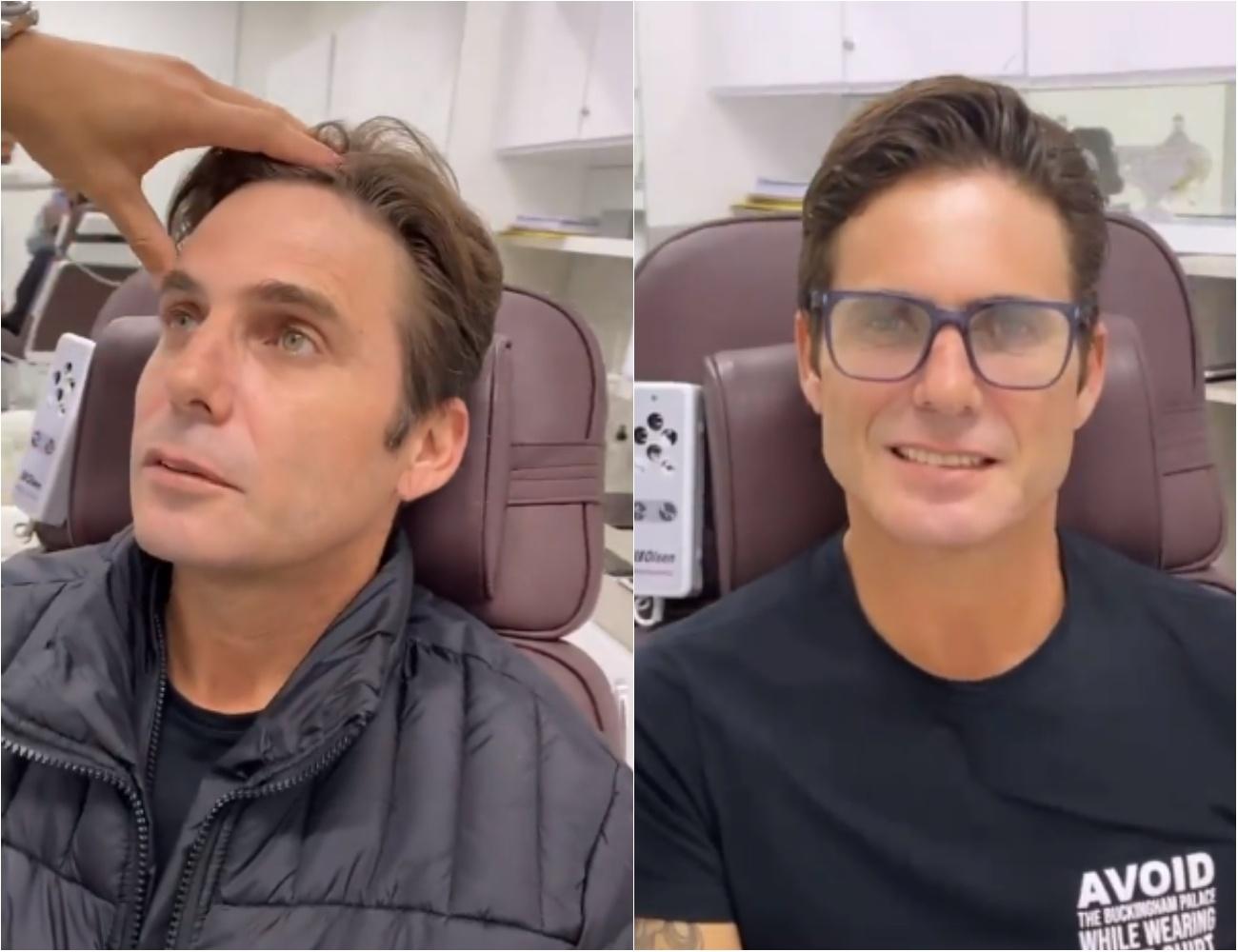 Cantor Hudson fez preenchimento no rosto seis meses depois de harmonização facial - Reprodução/Instagram