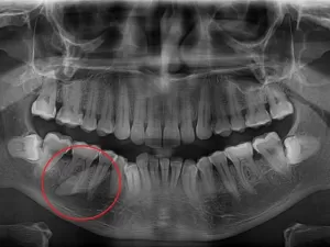 Homem descobre que dor na boca não era dente, mas pedra na glândula salivar