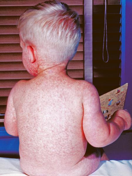 Em uma foto do Centro de Controle e Prevenção de Doenças, um menino com sarampo em 1963 - Centers for Disease Control and Prevention via The New York Times