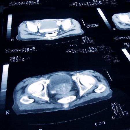Exame de imagem de câncer de próstata - Getty Images