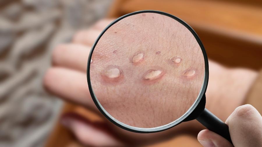 Um dos sintomas mais comuns da varíola dos macacos é a aparição de lesões cutâneas - iStock