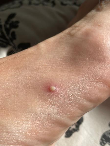 Blistering or acne-like rash on John's foot - Personal archive - Personal archive