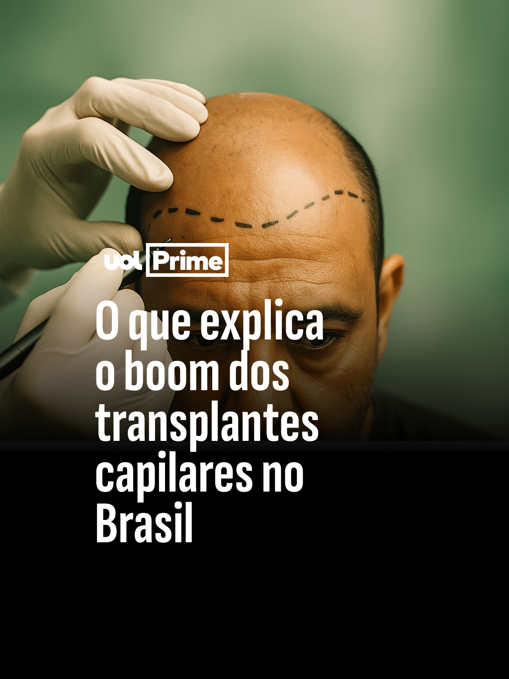 Malvino Salvador, Tadeu Schimdt, Rodrigo Faro: Famosos aderem ao transplante capilar