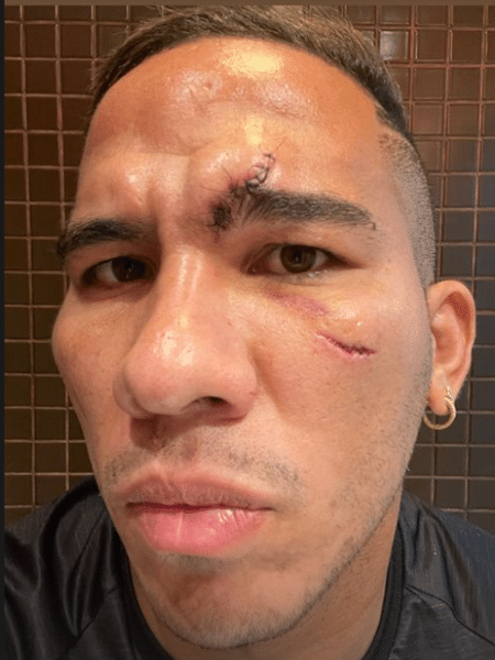 Atacante Jael, do Ceará, mostra rosto após disputa em Ceará x Palmeiras - Reprodução