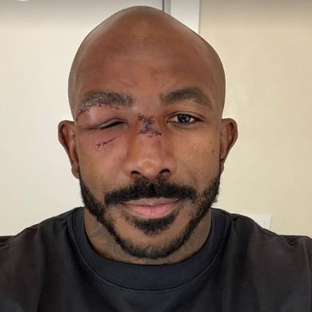 Rountree Jr. mostra como ficou o rosto após luta contra Alex Poatan no UFC