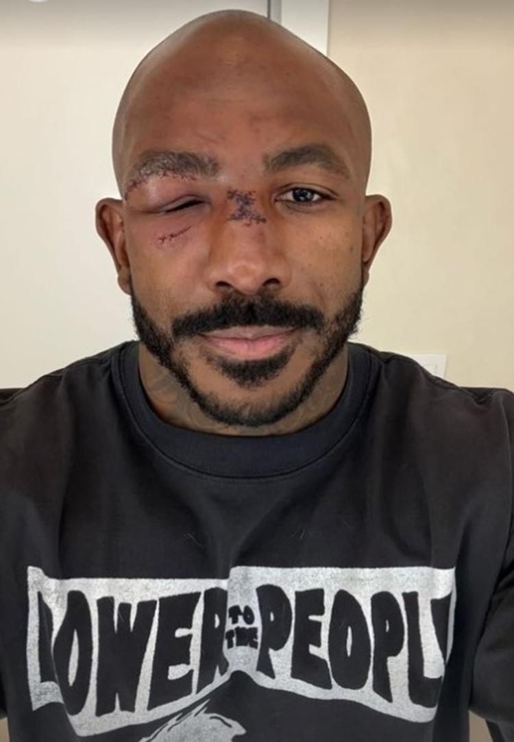 Rountree Jr. mostra como ficou o rosto após luta contra Alex Poatan no UFC