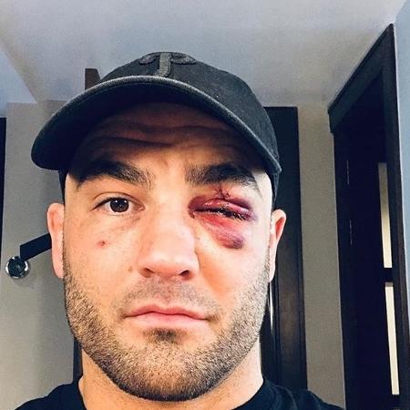 Eddie Alvarez, lesão no olho - Reprodução/Instagram