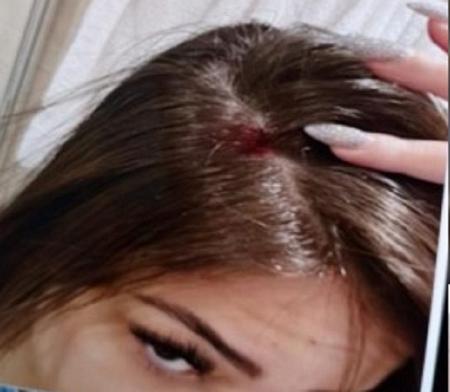 Gabriela exibe ferimento na cabeça